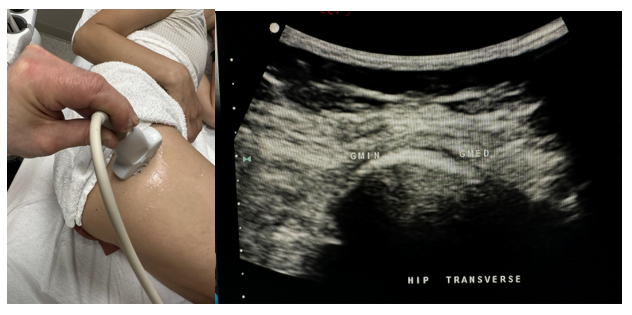 Side-by-side pictures of the transducer position and image of the gluteus minimus (GMIN) and gluteus medius (GMED) in the transverse plane. The abbreviations given here and labeled on the ultrasound image represent the corresponding structures.