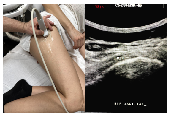 Side-by-side pictures of the transducer position and image of the gluteus medius (GMED) in the sagittal plane.