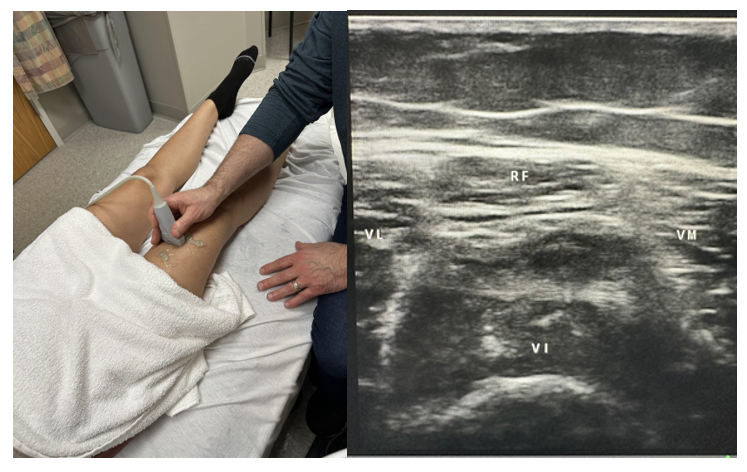 Side-by-side pictures of the transducer position and transverse image of rectus femoris (RF), vastus medialis (VM), vastus lateralis (VL), and vastus intermedius (VI). The abbreviations given here and labeled on the ultrasound image represent the corresponding structures.