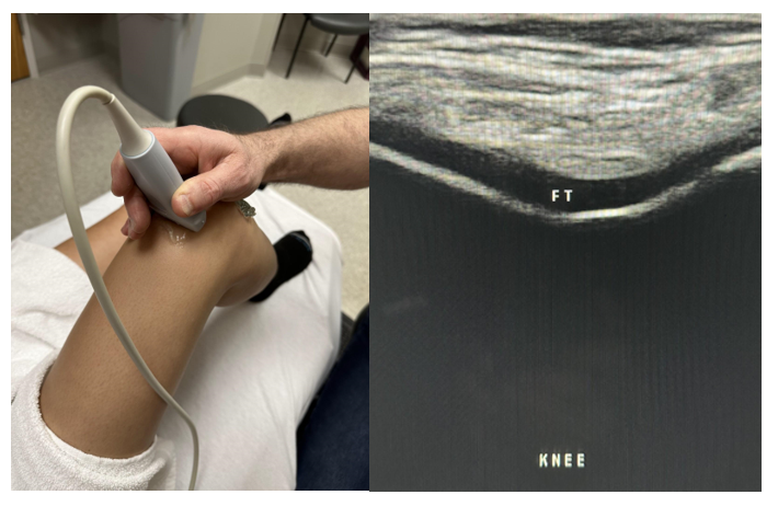 Side-by-side pictures of the transducer position and transverse image of the femoral trochlea (FT).