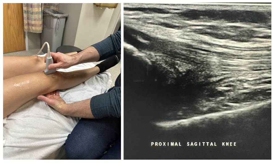 Side-by-side pictures of the transducer position and sagittal image of the proximal knee.