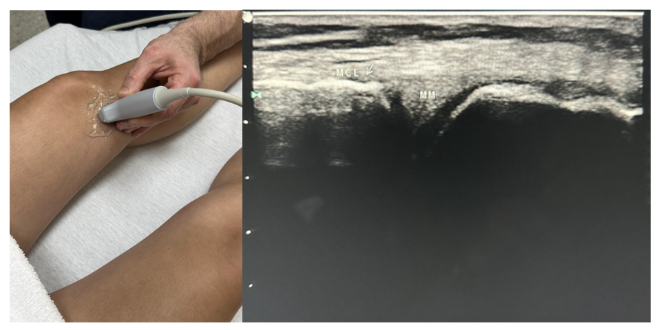 Side-by-side pictures of the ultrasound position and image of the medial meniscus (MM) and the medial collateral ligament (MCL). The abbreviations given here and labeled on the ultrasound image represent the corresponding structures.