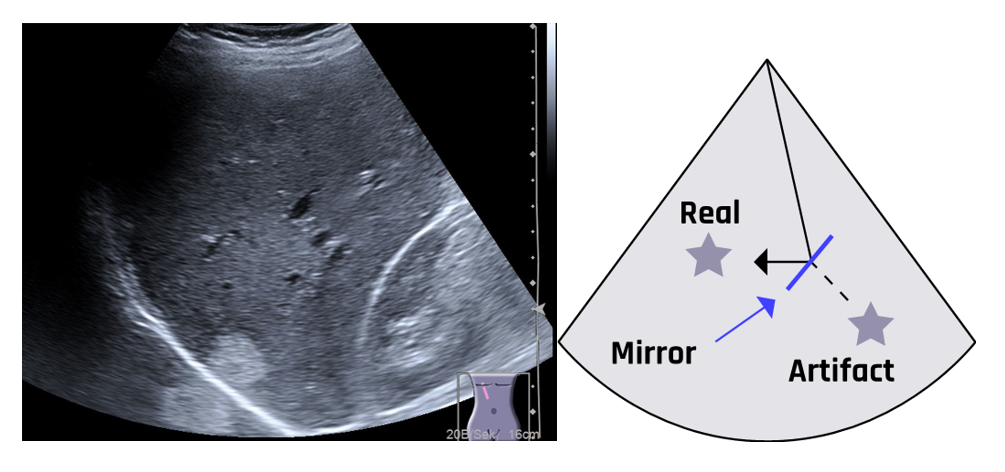 A mirror image artifact appears as a symmetric image with less intensity than the actual image on the opposite side of the baseline. The mirror image artifact is apparently outside the liver.