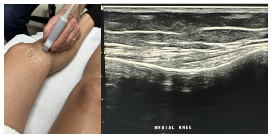 Side-by-side pictures of the transducer position and image of the pes anserine complex (PA).