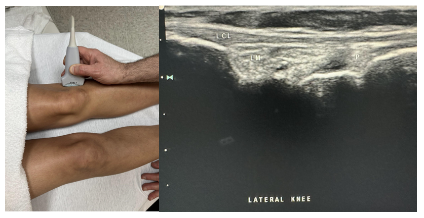 Side-by-side pictures of the transducer position and image of the lateral meniscus (LM), lateral collateral ligament (LCL), and popliteus (P). The abbreviations given here and labeled on the ultrasound image represent the corresponding structures.