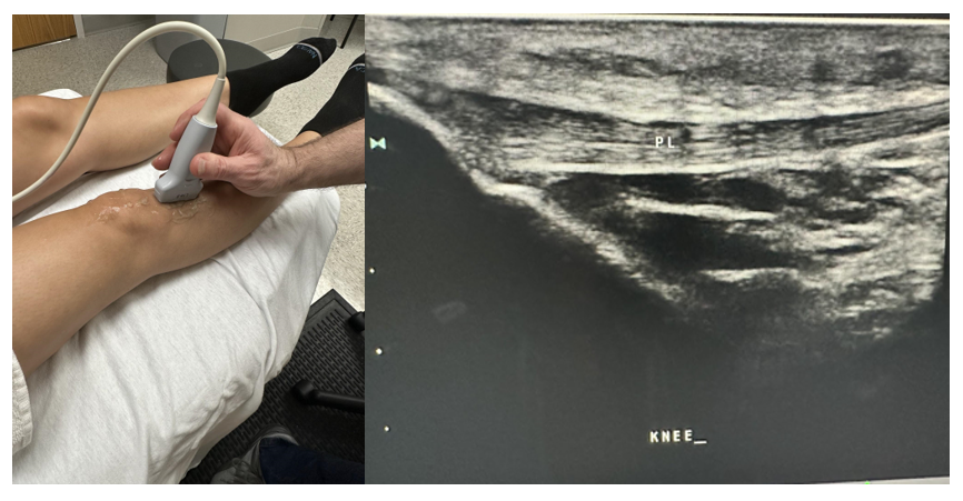 Side-by-side pictures of the sagittal image of the patellar ligament (PL).