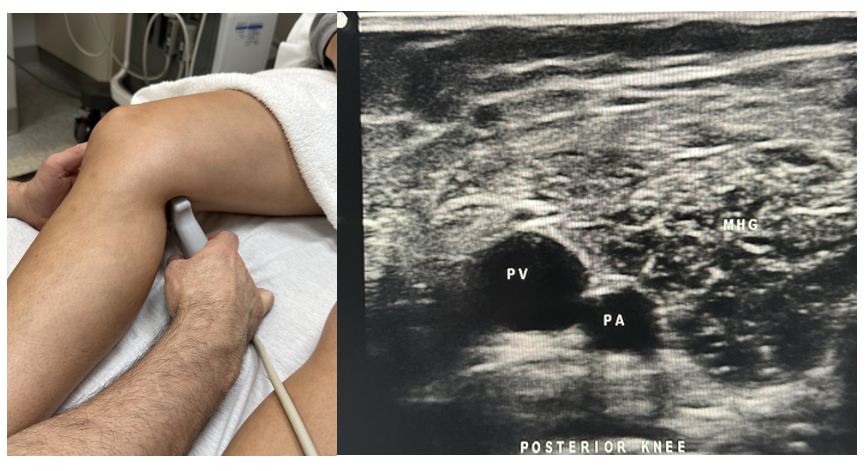 Side-by-side pictures of the transducer position and transverse image of the posterior knee viewing of the medial head of the gastrocnemius muscle (MHG), popliteal artery (PA), and the popliteal vein (PV). The abbreviations given here and labeled on the ultrasound image represent the corresponding structures.