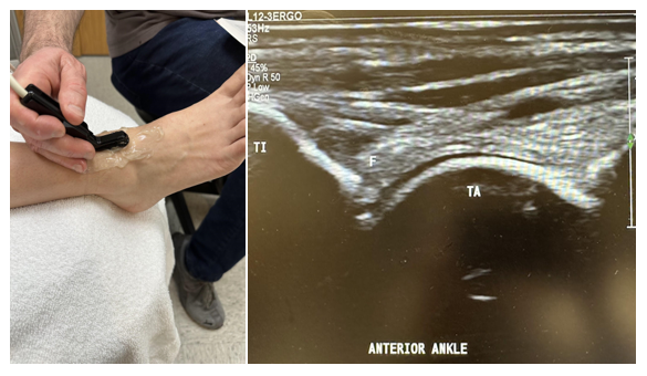 Side-by-side pictures of the transducer position and sagittal image of the anterior ankle, including the tibia (TI), talus (TA), and anterior fat pad (F). The abbreviations given here and labeled on the ultrasound image represent the corresponding structures.