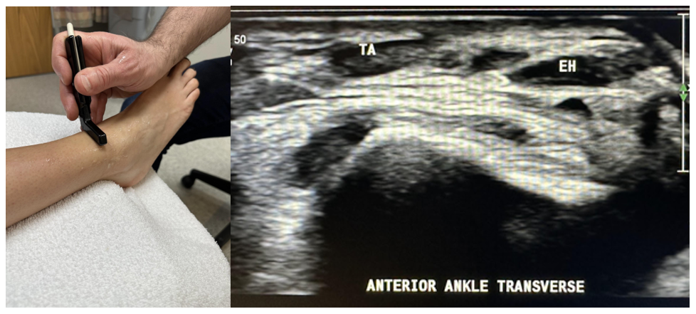 Side-by-side pictures of the transducer position and transverse image of the tibialis anterior (TA) and extensor hallucis (EH) in the ankle. The abbreviations given here and labeled on the ultrasound image represent the corresponding structures.