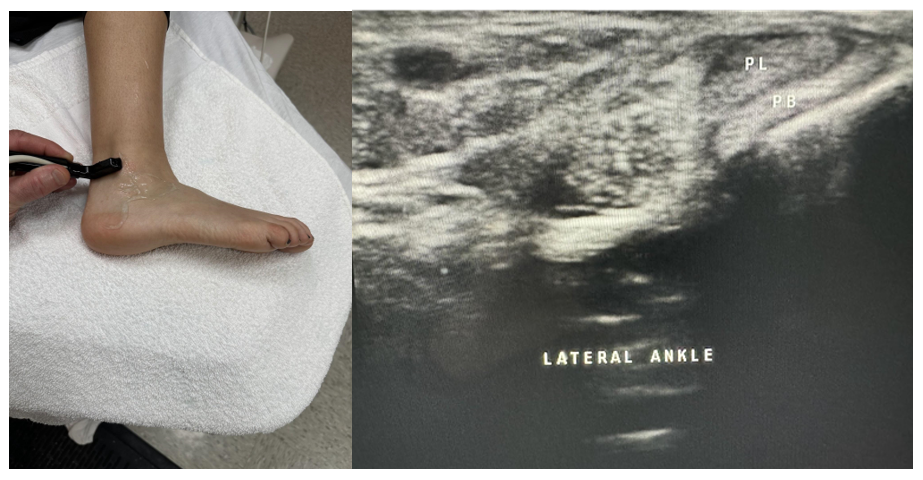 Side-by-side pictures of the transducer position and transverse image of peroneus brevus (PB) and peroneus longus (PL). The abbreviations given here and labeled on the ultrasound image represent the corresponding structures.