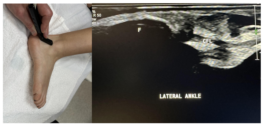 Side-by-side pictures of the transducer position and sagittal image of the calcaneofibular ligament (CFL), calcaneus (C), and fibula (F). The abbreviations given here and labeled on the ultrasound image represent the corresponding structures.