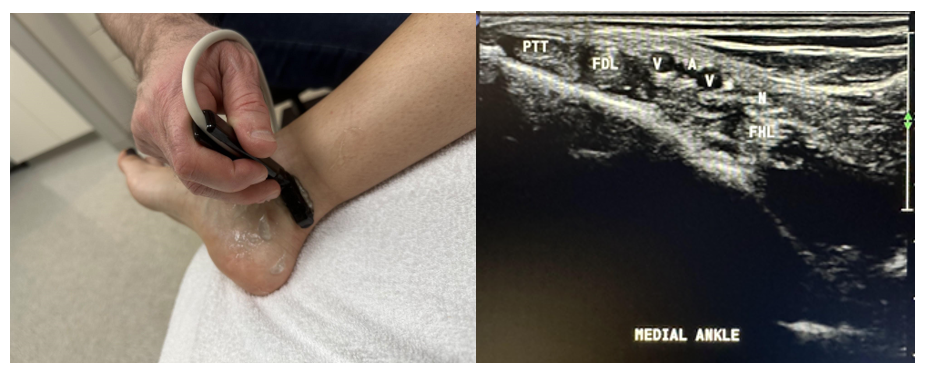 Side-by-side pictures of the transducer position and transverse image of the medial ankle, including the medial malleolus (MM), tibialis posterior tendon (PTT), flexor digitorum longus tendon (FDL), posterior tibial vein (V) and artery (A), tibial nerve (N), and flexor hallucis longus tendon (FHL). The abbreviations given here and labeled on the ultrasound image represent the corresponding structures.