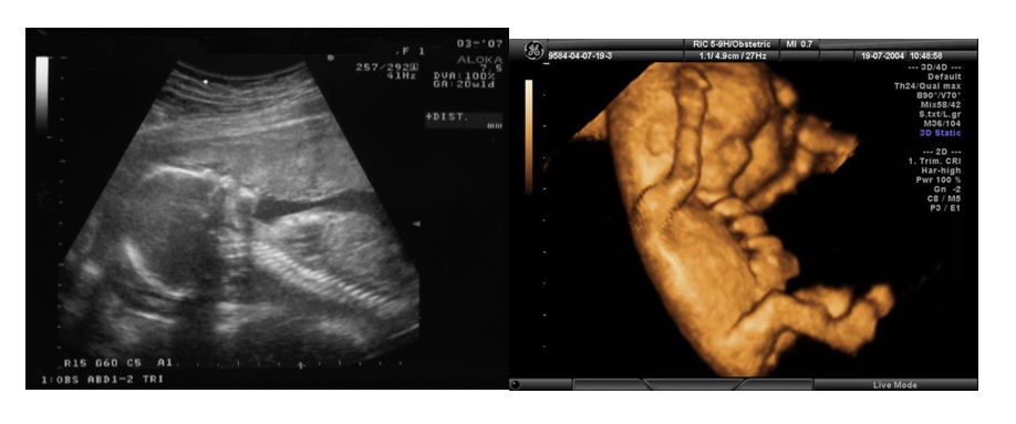 2D grayscale image on the left and 3D colored image on the right.