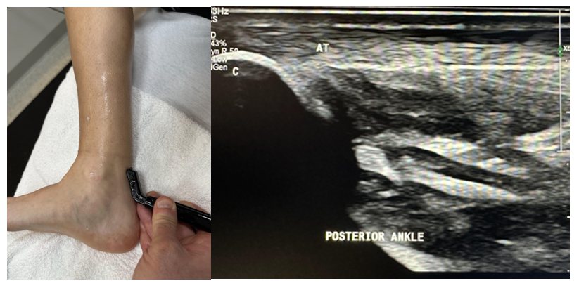 Side-by-side pictures of the transducer position and posterior ankle sagittal view of the Achilles tendon (AT) insertion into the calcaneus (C). The abbreviations given here and labeled on the ultrasound image represent the corresponding structures.