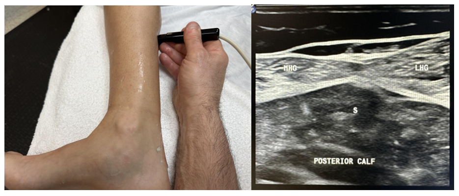 Side-by-side pictures of the transducer position and posterior calf transverse image include the medial head of the gastrocnemius muscle (MHG), the lateral head of the gastrocnemius muscle (LHG), and the soleus muscle (S). The abbreviations given here and labeled on the ultrasound image represent the corresponding structures.