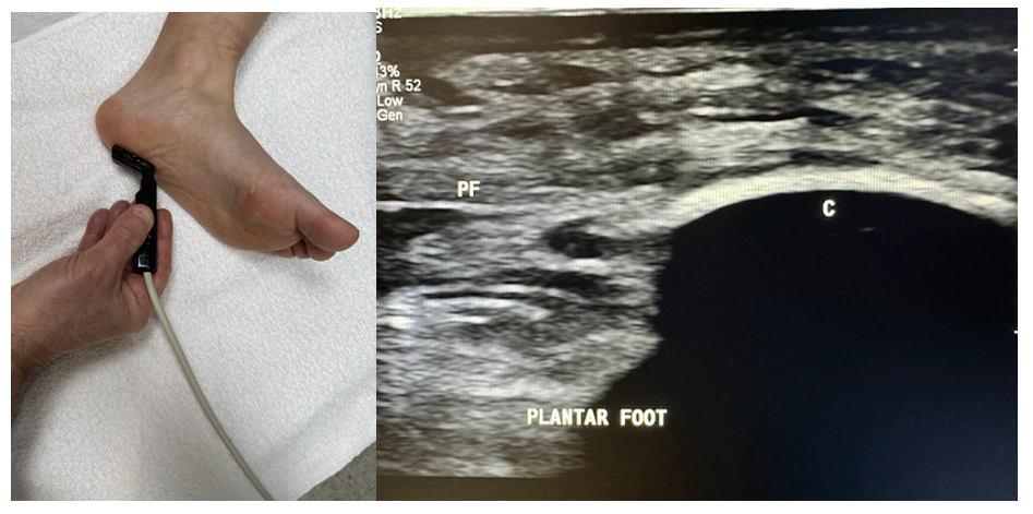 Side-by-side pictures of the transducer position and plantar sagittal view with plantar fascia (PF) insertion into the calcaneus (C). The abbreviations given here and labeled on the ultrasound image represent the corresponding structures.