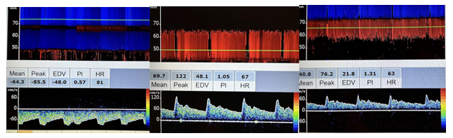 Side-by-side flow patterns and velocities of the anterior cerebral artery, middle cerebral artery, and posterior cerebral artery on transcranial Doppler.