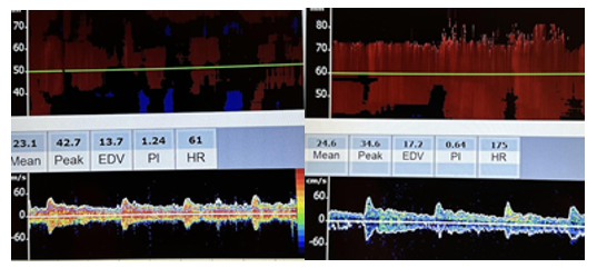 Side-by-side velocities and flow patterns of the right ophthalmic artery and carotid siphon on transcranial Doppler.