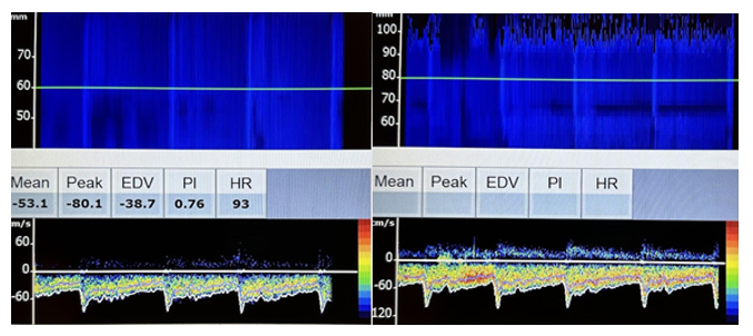 Side-by-side velocities and flow patterns of the left vertebral artery and basilar artery on transcranial Doppler.