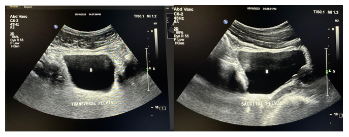 Ultrasound of the bladder.