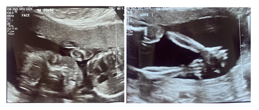 Ultrasound images of a fetus’s face and arms during week 20.