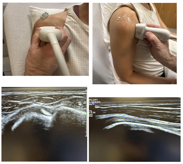 Structure of the biceps tendon viewed in the transverse and longitudinal planes.