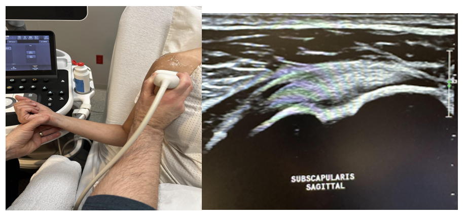 Examination of the subscapularis tendon in the sagittal plane.